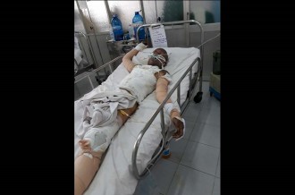 Anh Dũng hiện đang điều trị tại phòng số 3, lầu 4, Khoa Bỏng, Bệnh viện Chợ Rẫy TP.HCM với hơn 50% cơ thể bị bỏng và bội nhiễm hơi xăng mô phổi, suy hô hấp nặng ẢNH: BẢO VĂN