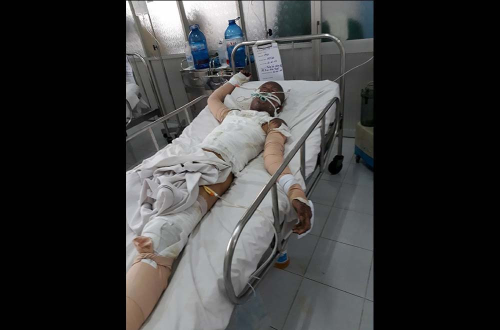 Anh Dũng hiện đang điều trị tại phòng số 3, lầu 4, Khoa Bỏng, Bệnh viện Chợ Rẫy TP.HCM với hơn 50% cơ thể bị bỏng và bội nhiễm hơi xăng mô phổi, suy hô hấp nặng ẢNH: BẢO VĂN